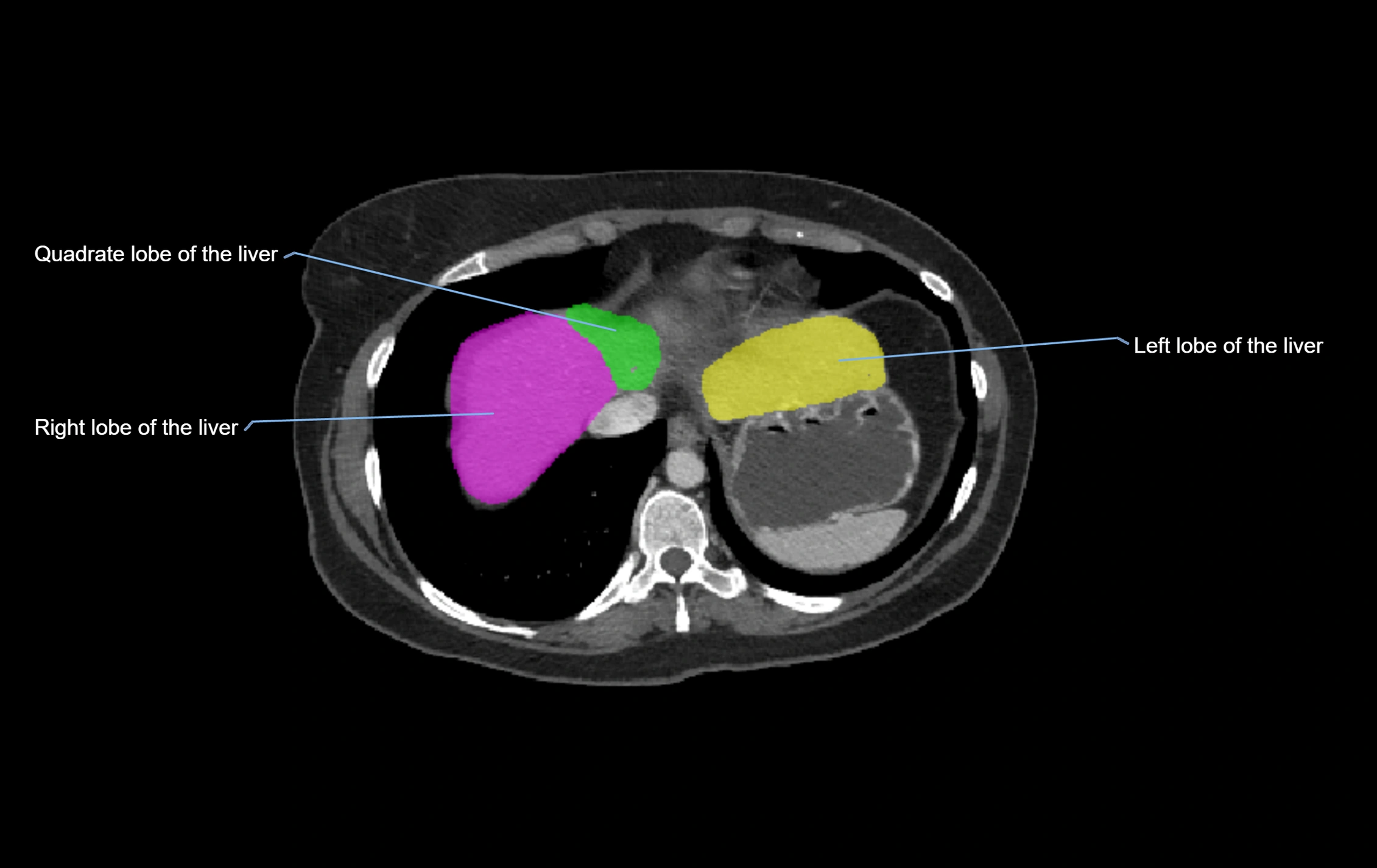 CT lliver lobes axial cross sectional anatomy labelled image -00071.webp